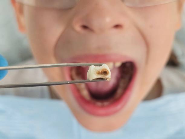 Best Emergency Dentist for Knocked-Out Tooth in Union City, OH